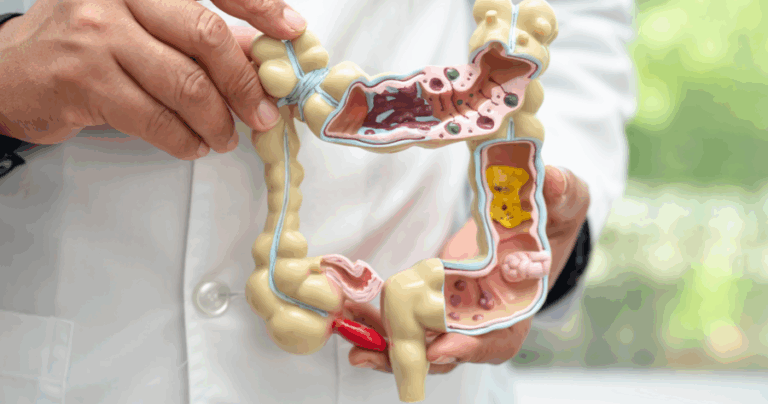 รู้จักอาการลําไส้แปรปรวน วิธีรักษา และดูแลตัวเองอย่างไรบ้าง